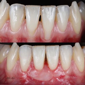 Before and After Gum Grafting